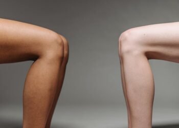 Flacidez nas Coxas: Causas, Tratamentos e Como Prevenir